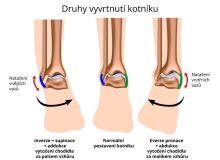 druhy-vyvrtnuti-kotniku_zdroj_symptomy.cz[1]