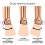 druhy-vyvrtnuti-kotniku_zdroj_symptomy.cz[1]