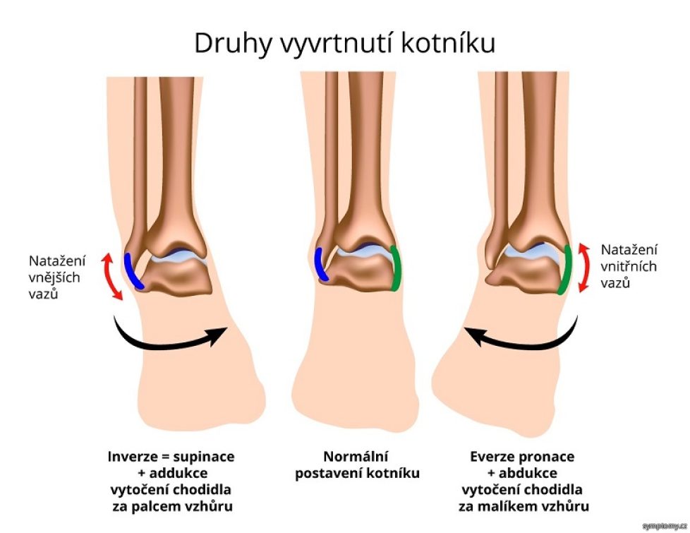 druhy-vyvrtnuti-kotniku_zdroj_symptomy.cz[1]